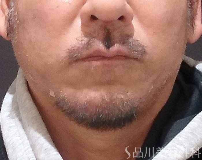 症例NO.69684のAFTER写真