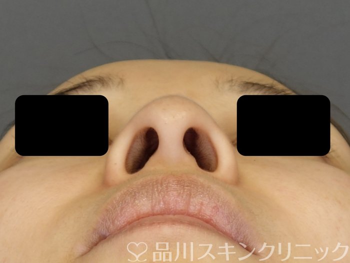 症例NO.73745のBEFORE写真