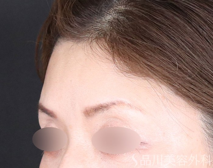 症例NO.72691のBEFORE写真