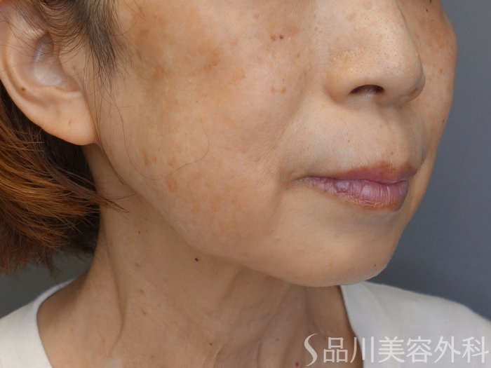 症例NO.70939のBEFORE写真