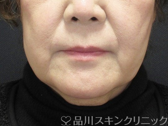 症例NO.69689のBEFORE写真