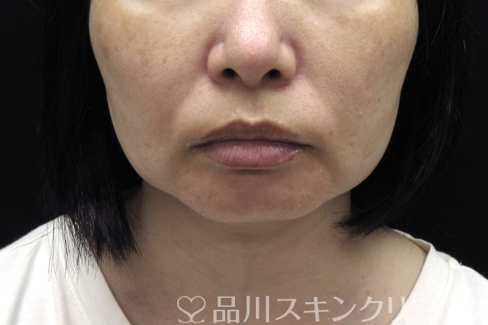 症例NO.74421のBEFORE写真