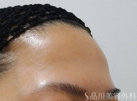 症例NO.72380のBEFORE写真