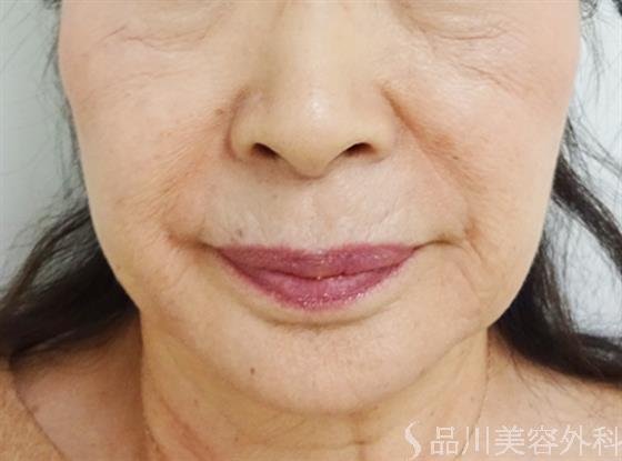 症例NO.33025のAFTER写真