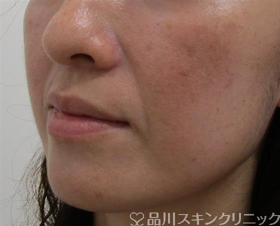 症例NO.38649のBEFORE写真