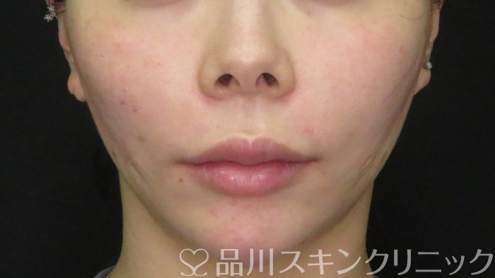 症例NO.70882のAFTER写真
