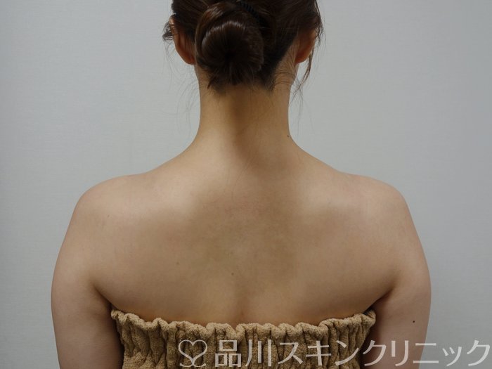 症例NO.73474のAFTER写真