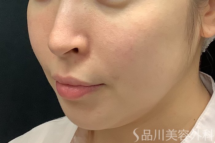 症例NO.71243のBEFORE写真