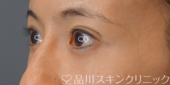 症例NO.73839のAFTER写真