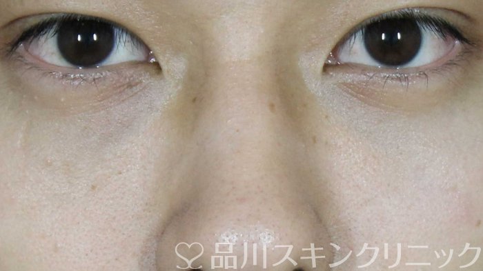 症例NO.72073のAFTER写真