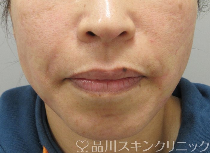 症例NO.69810のAFTER写真