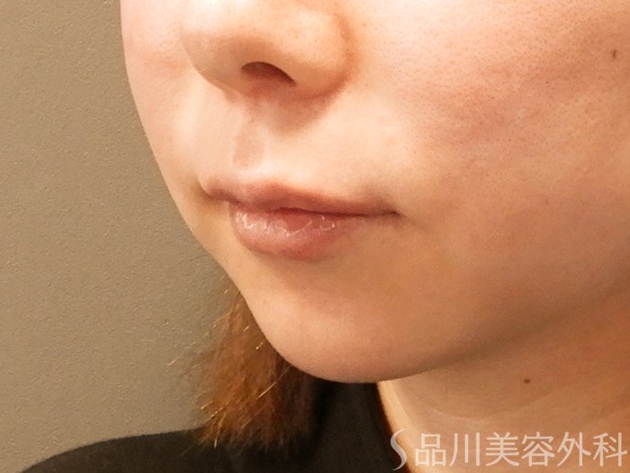 症例NO.70058のAFTER写真