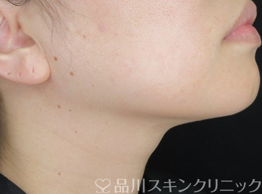 症例NO.70169のBEFORE写真
