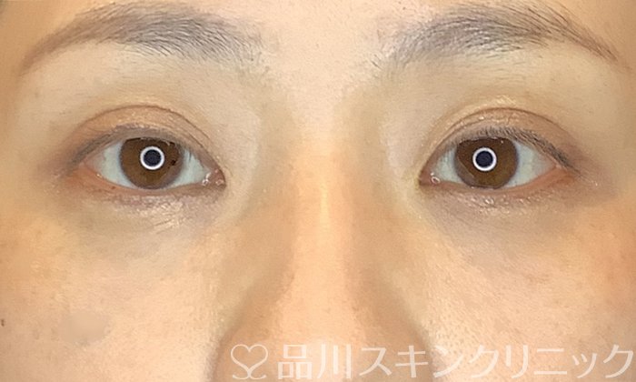 症例NO.70941のAFTER写真