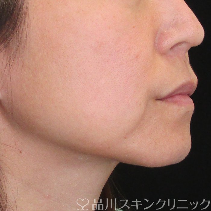 症例NO.75073のBEFORE写真
