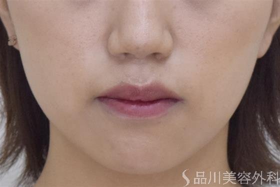 症例NO.49292のBEFORE写真