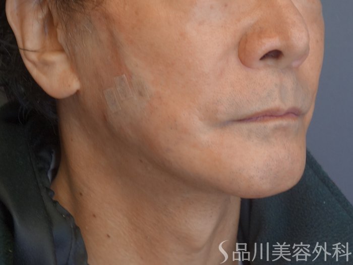 症例NO.72093のAFTER写真