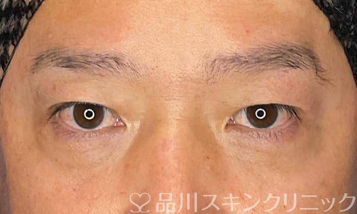 症例NO.74704のBEFORE写真