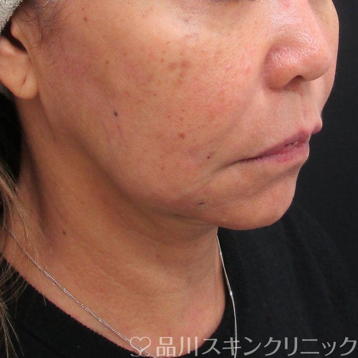 症例NO.74580のAFTER写真