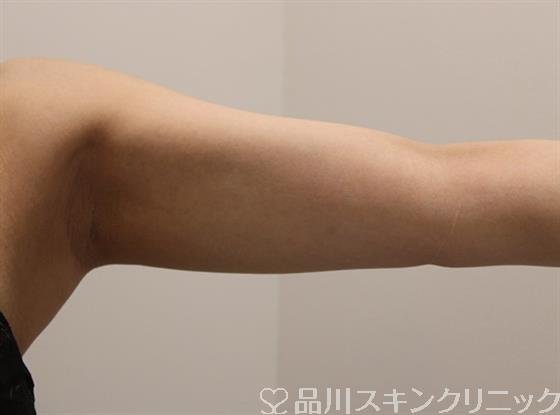 症例NO.46039のAFTER写真