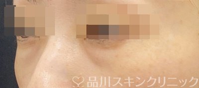 症例NO.62588のBEFORE写真