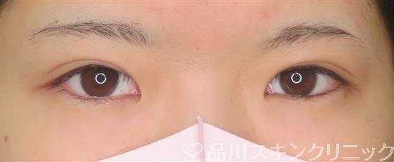 症例NO.60162のAFTER写真