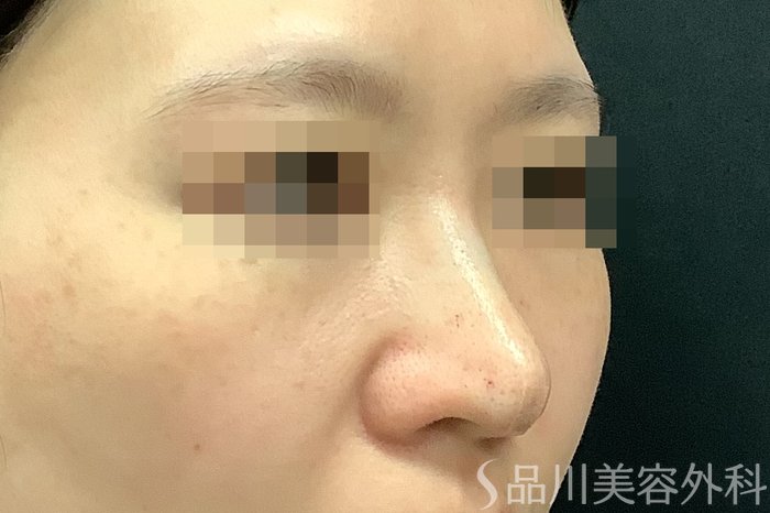 症例NO.71249のAFTER写真