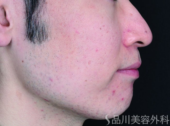 症例NO.70964のAFTER写真