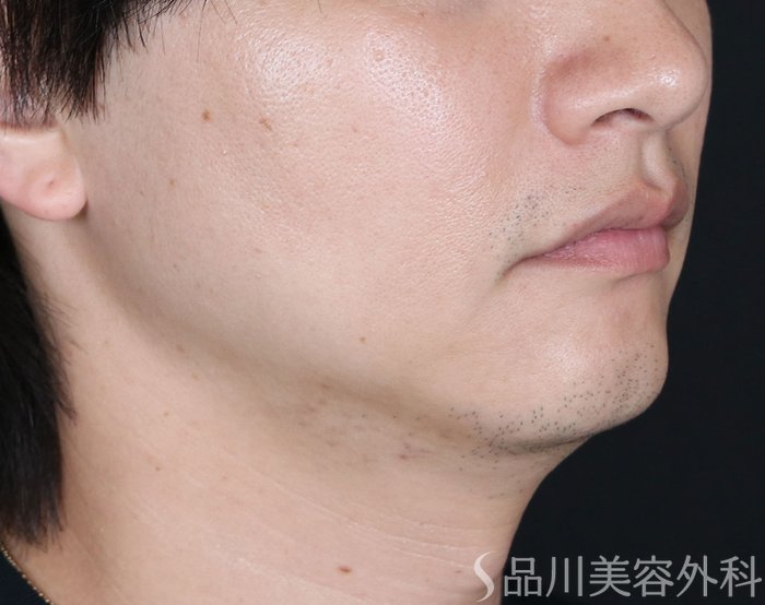 症例NO.71070のAFTER写真