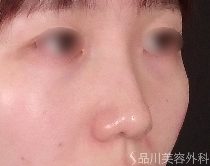 症例NO.69294のBEFORE写真