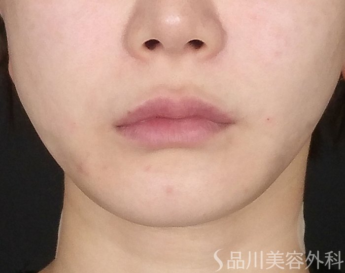 症例NO.65488のAFTER写真