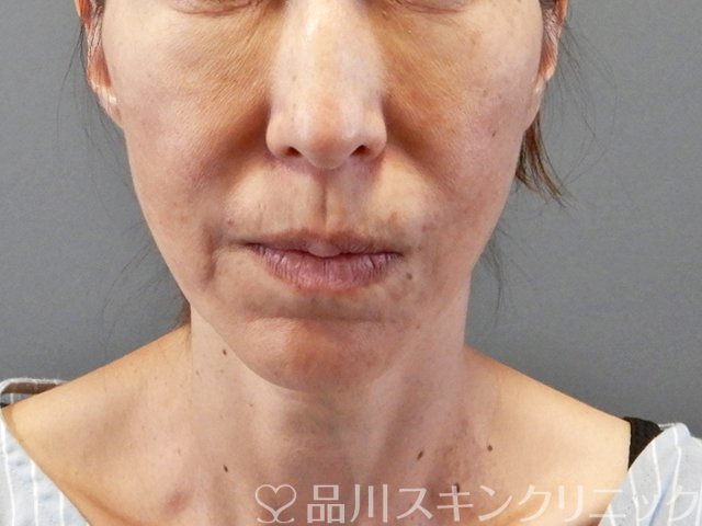 症例NO.66572のBEFORE写真