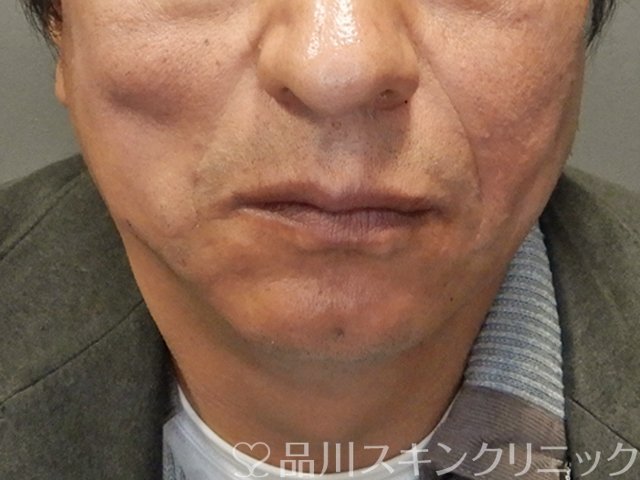 症例NO.75134のAFTER写真