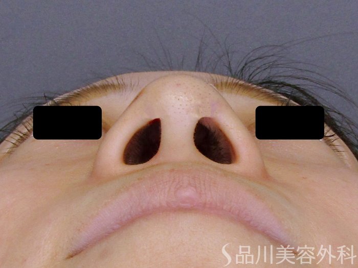 症例NO.74892のAFTER写真