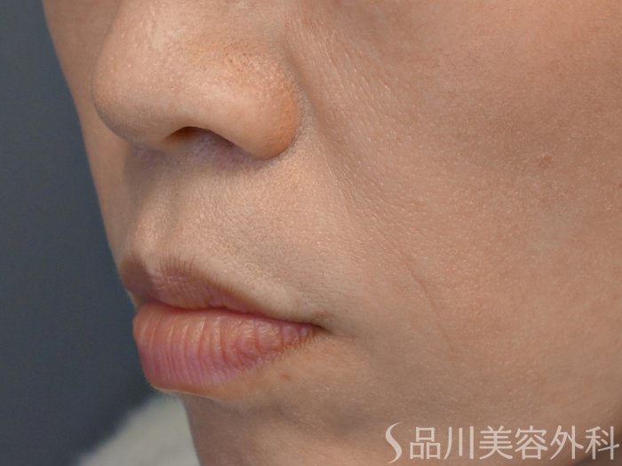 症例NO.67890のBEFORE写真