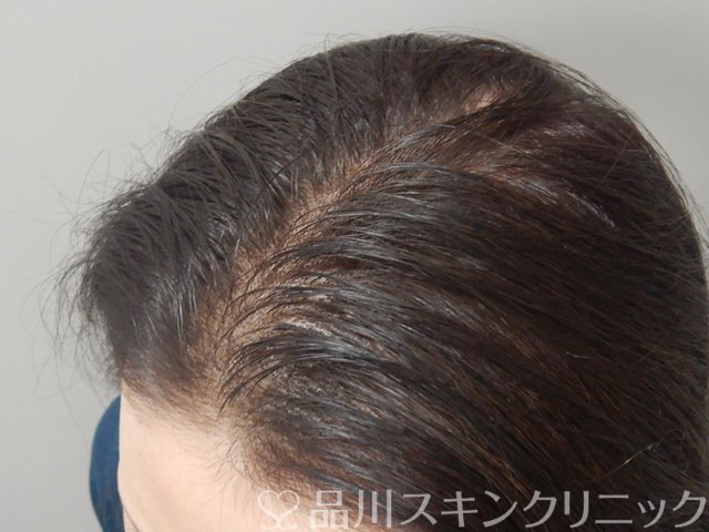 症例NO.68636のAFTER写真
