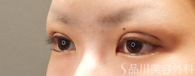 症例NO.72030のAFTER写真