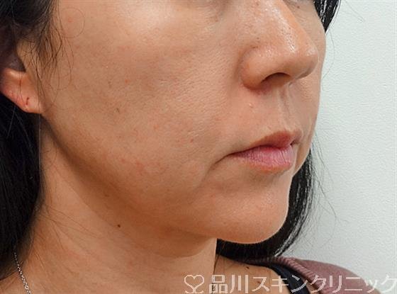症例NO.25796のBEFORE写真