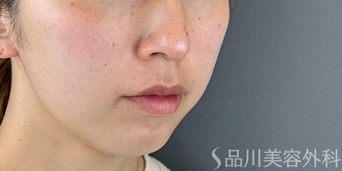 症例NO.69461のBEFORE写真