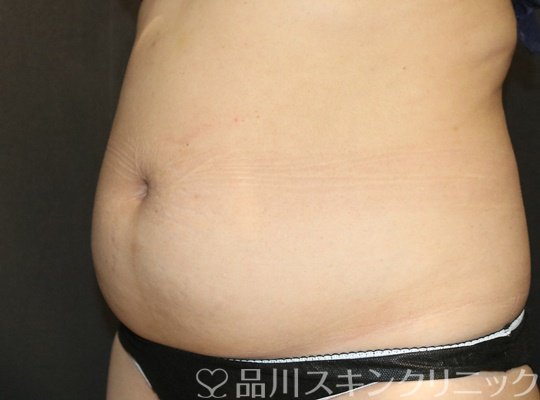 症例NO.73888のBEFORE写真