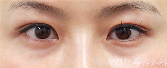 症例NO.50332のAFTER写真