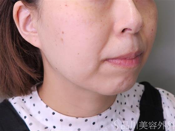 症例NO.48150のBEFORE写真