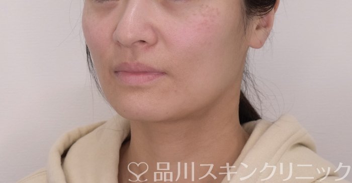 症例NO.69365のBEFORE写真