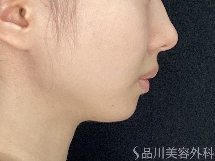 症例NO.71630のBEFORE写真