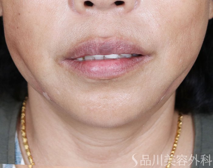 症例NO.71755のAFTER写真