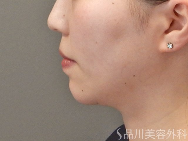 症例NO.75130のAFTER写真