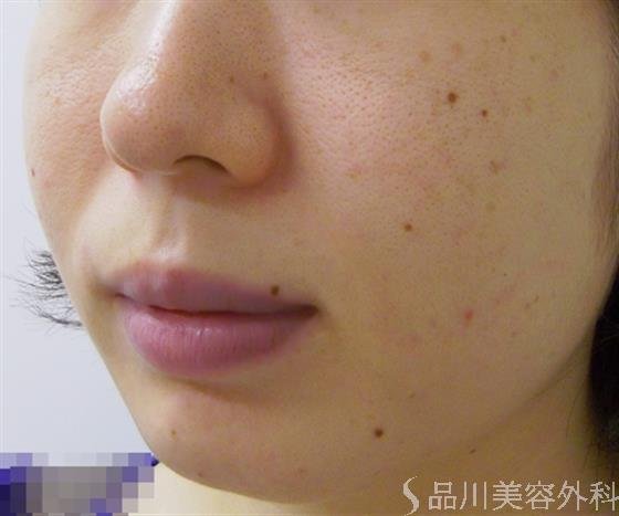 症例NO.27816のBEFORE写真