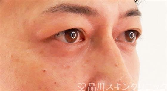 症例NO.61695のAFTER写真