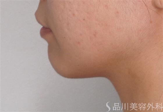 症例NO.48319のBEFORE写真