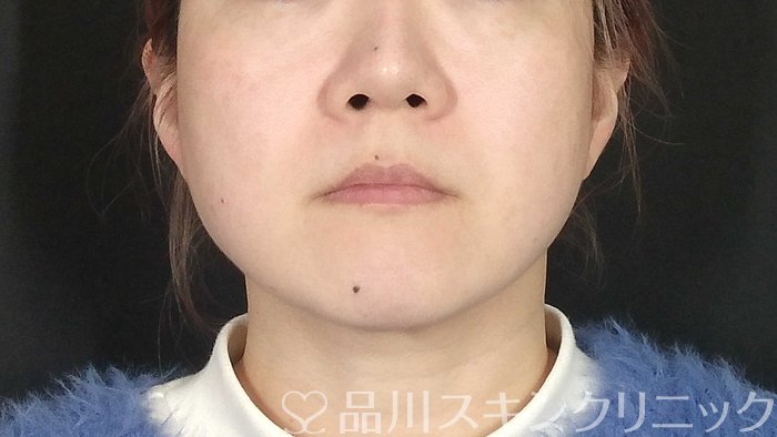 症例NO.72998のBEFORE写真